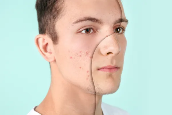 akne sivilce tedavisi