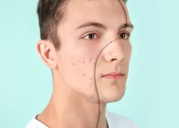 Akne/Sivilce Tedavisi