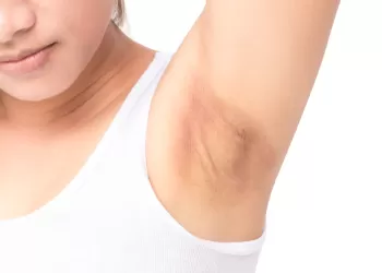 Akantozis Nigrikans Neden Olur? Koltuk Altı ve Ensede Koyulaşma