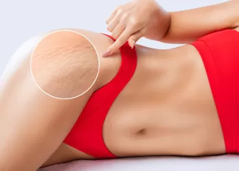 Cilt Çatlakları (Stria) Neden Olur? Nasıl Geçer?