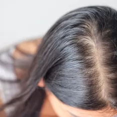 Androgenetik Alopesi (Erkek Tipi Saç Dökülmesi)