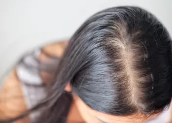 Androgenetik Alopesi (Erkek Tipi Saç Dökülmesi)