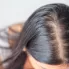 Androgenetik Alopesi (Erkek Tipi Saç Dökülmesi)