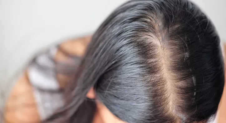 Androgenetik Alopesi (Erkek Tipi Saç Dökülmesi)