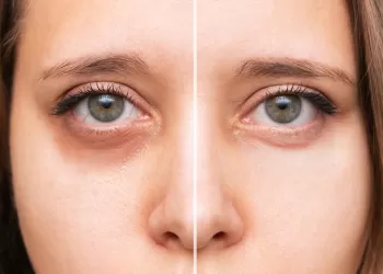 Göz Çevresi Koyu Halkalar ve Şişlikler İçin Öneriler