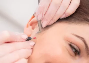 İğneli Epilasyon Tedavisi