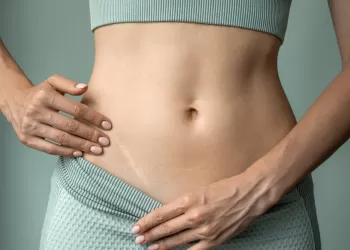 İz Tedavisi Nasıl Yapılır?