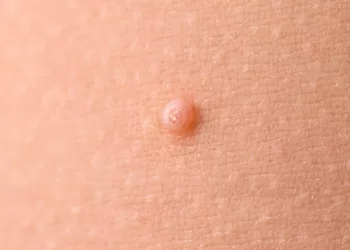 Molluskum Kontagiosum Nedir?