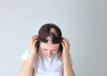 Saçkıran (Alopesi Areata) Hastalığı