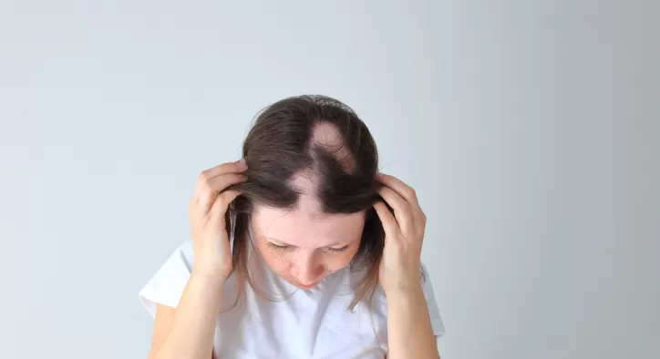 Saçkıran (Alopesi Areata) Hastalığı