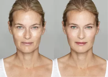 Somon DNA Nedir? - Somon DNA Tedavisinin Detayları