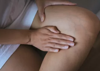 Genç Yaşta Varis Neden Olur? Erken Yaşta Varis Görülmesi Neyin Habercisidir?