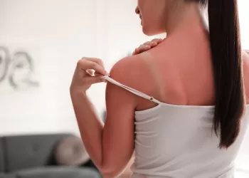 Güneş Yanığına Ne İyi Gelir?