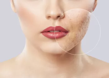 Lazerle Akne ve Yara İzi Tedavisi