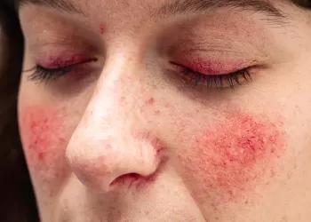 Rosacea (Gül Hastalığı)