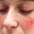 Rosacea (Gül Hastalığı)