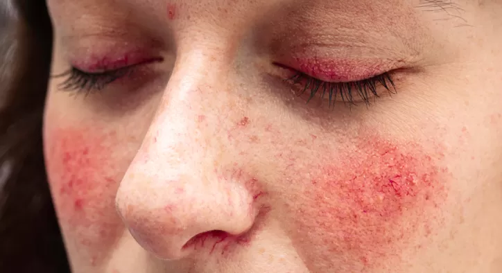 Rosacea (Gül Hastalığı)