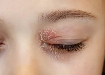 İltihaplı Deri Hastalıkları ve Tedavi Yöntemleri